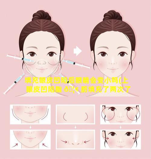 填充眼皮凹陷后眼睛会变小吗(上眼皮凹陷脂 🦢 肪填充了两次了还是凹 🐬 陷)